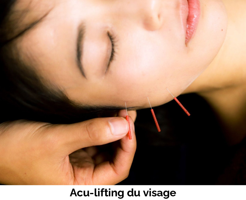 Formation aculifting accueil