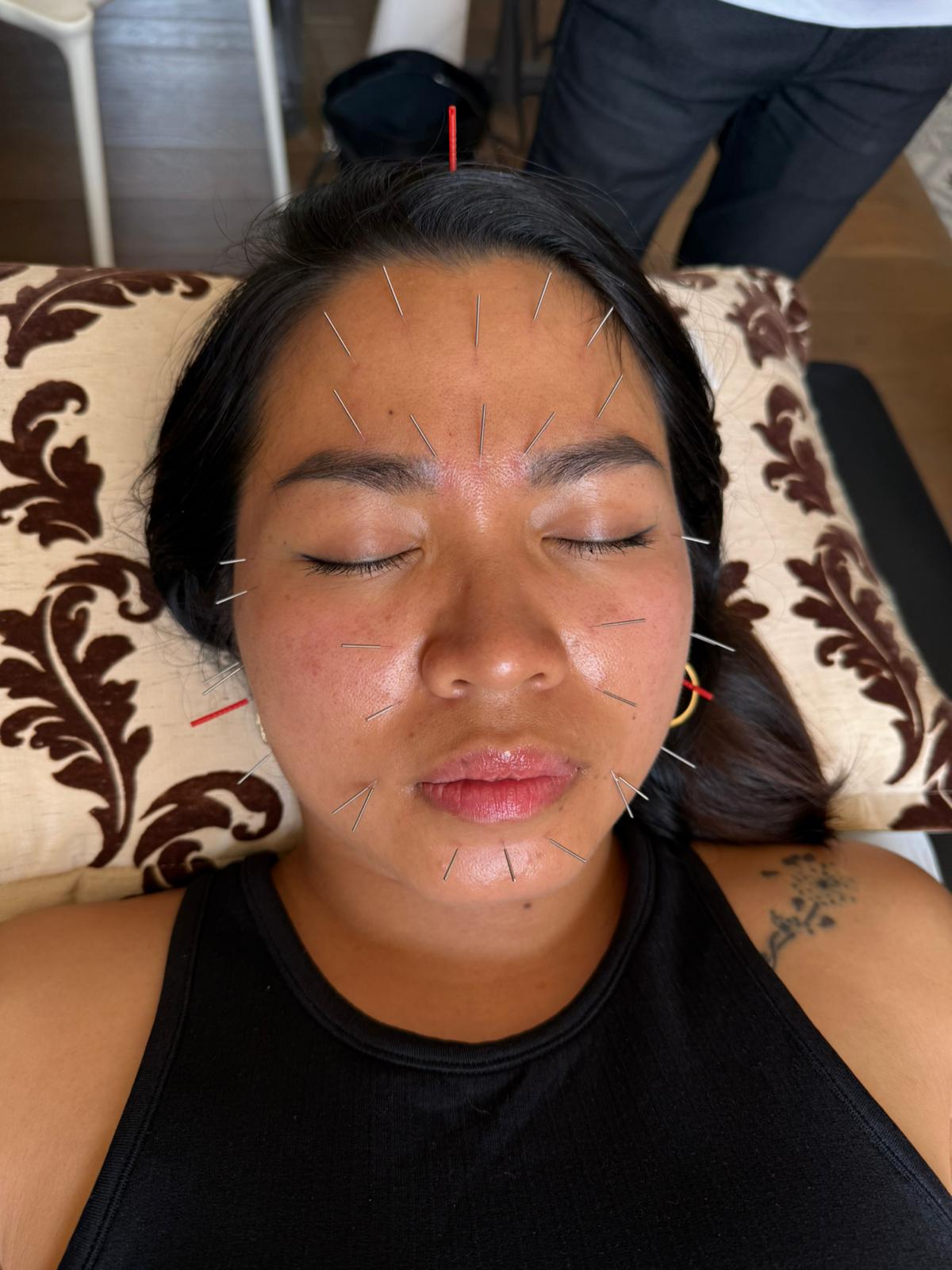 aculifting du visage nguyen