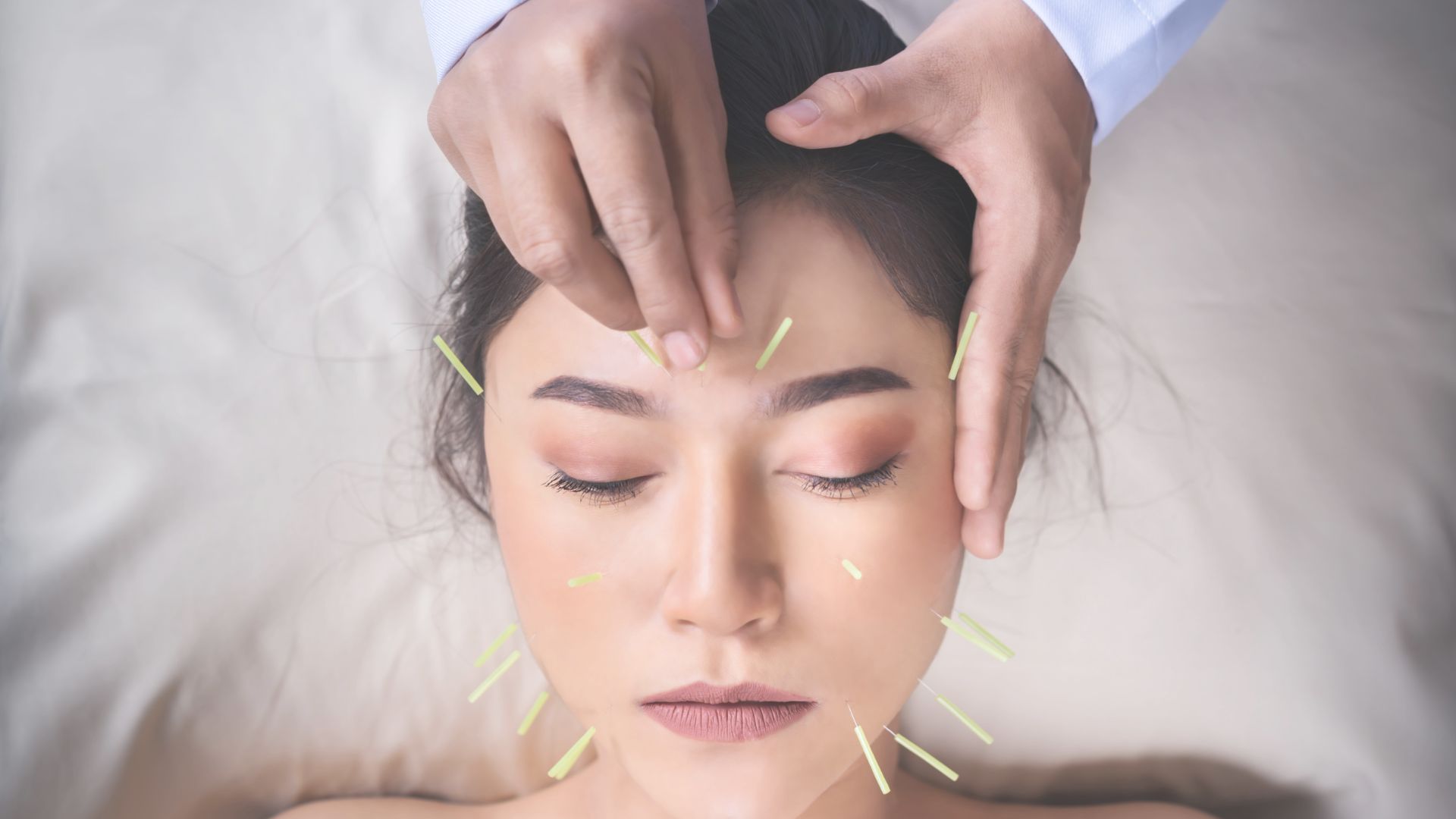 Lifting par acupuncture : formations à l’aculifting du visage